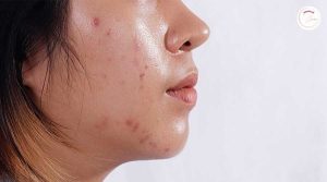 da dầu cần sử dụng sữa rửa mặt cho da dầu