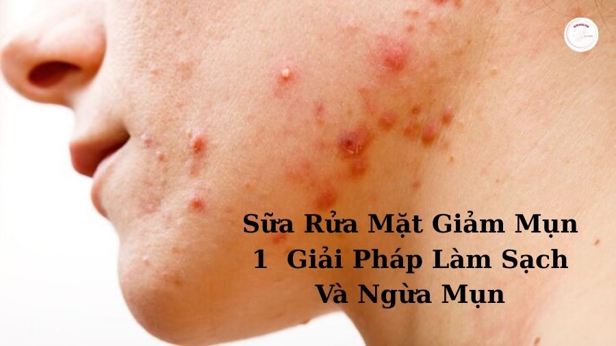 Sữa-rửa-mặt-giảm-mụn