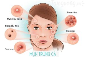 tác hại của nước tẩy trang khi dùng sai cách mà ai cũng nên biết