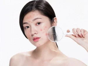 Tẩy trang dịu nhẹ cho da mụn: Bí quyết làm sạch không gây kích ứng